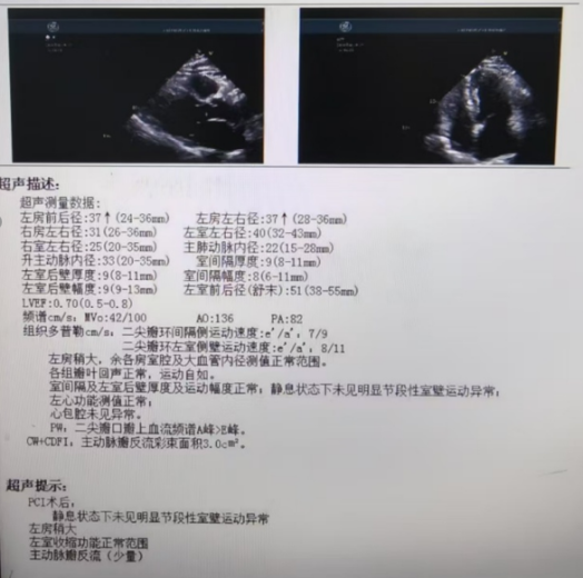 以柔克刚,事半功倍——OCT指导下冲击波球囊处理严重冠脉钙化病变