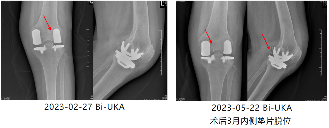 UKA术后对侧间室进展性OA的治疗策略(二期Bi-UKA)