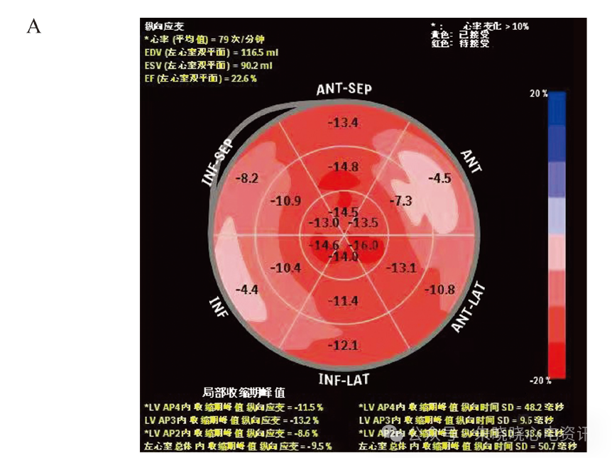 误诊为肥厚型心肌病的法布雷病