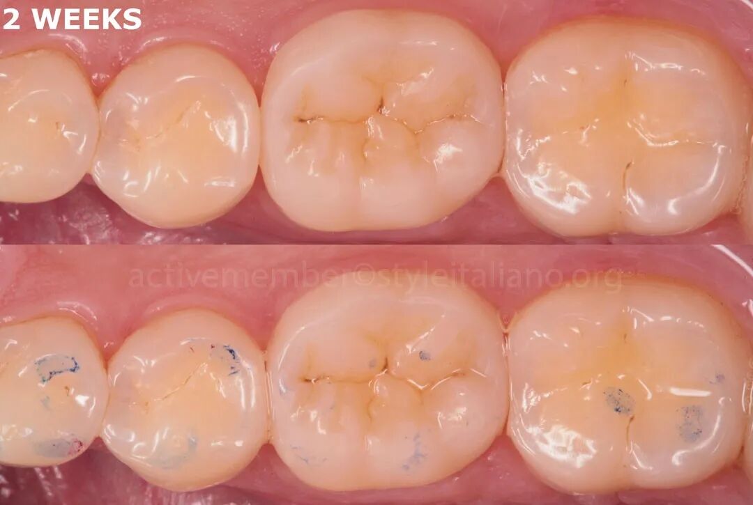 SPO超嵌体预备