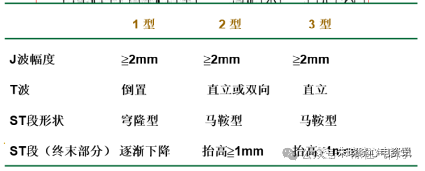 超全讲解！ST段抬高的识别及相关疾病的鉴别