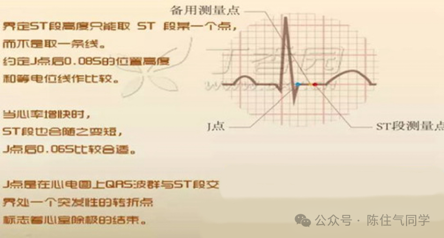 超全讲解！ST段抬高的识别及相关疾病的鉴别