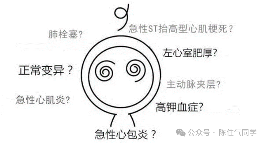 超全讲解！ST段抬高的识别及相关疾病的鉴别