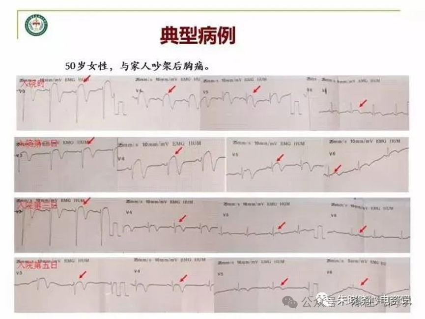 超全讲解！ST段抬高的识别及相关疾病的鉴别