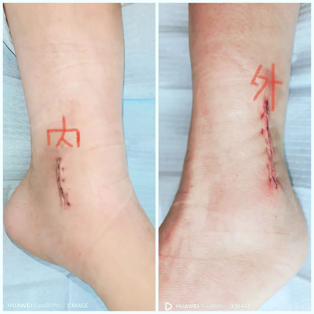 踝关节标准透视的重要性