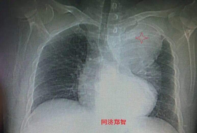 没有CTA？这三招也能识别主动脉夹层！