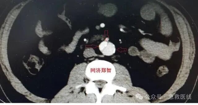 没有CTA？这三招也能识别主动脉夹层！