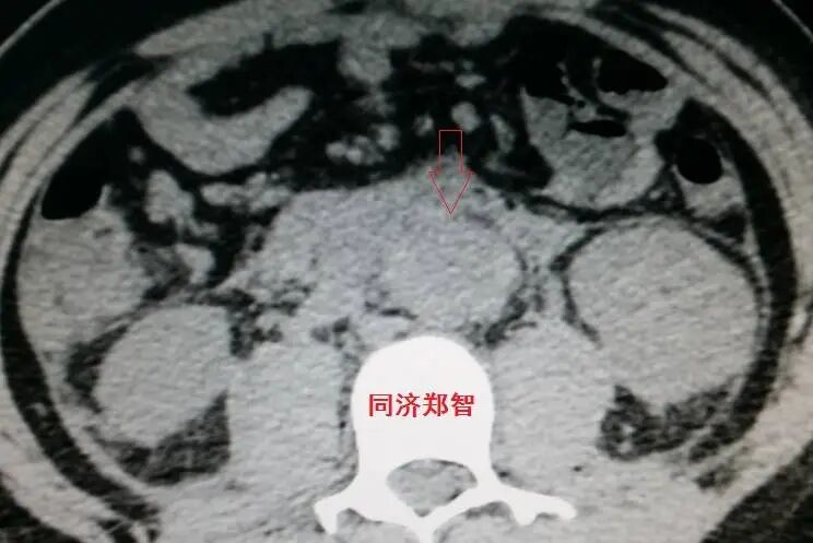 没有CTA？这三招也能识别主动脉夹层！