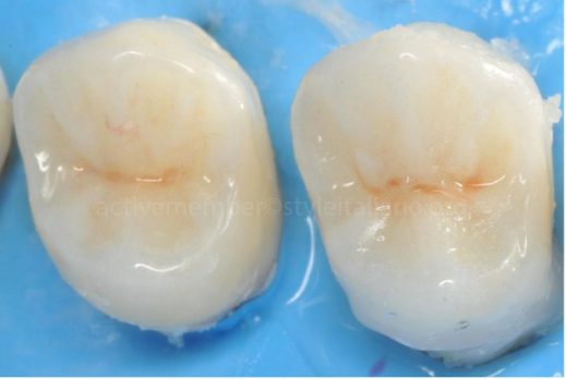 髓腔固位冠，是否可行？