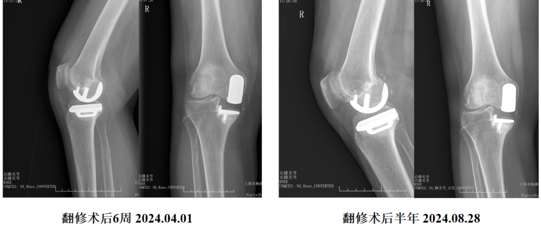单髁置换术后无菌性松动的治疗策略
