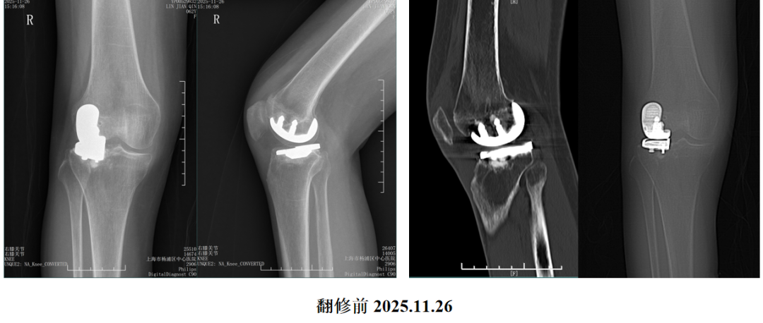 单髁置换术后无菌性松动的治疗策略