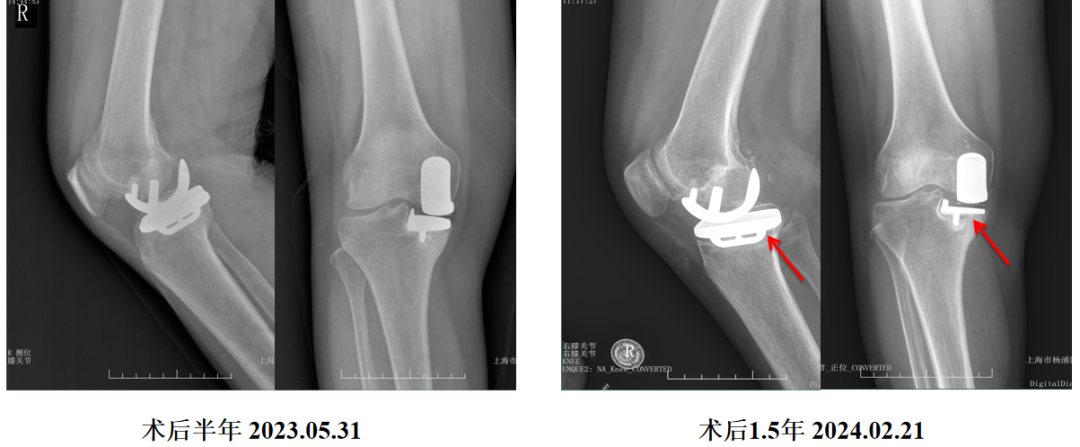 单髁置换术后无菌性松动的治疗策略