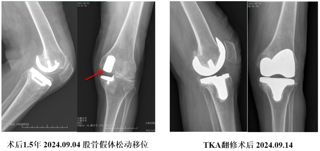 单髁置换术后无菌性松动的治疗策略
