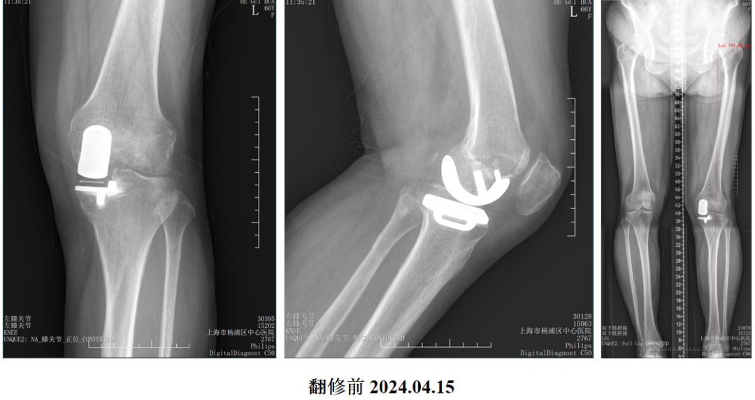 单髁置换术后无菌性松动的治疗策略