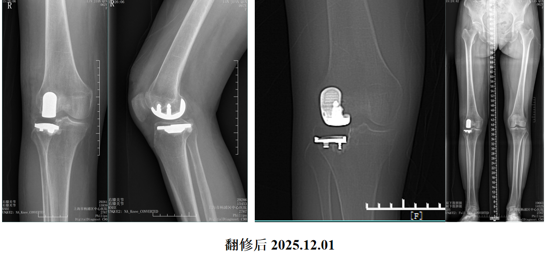 单髁置换术后无菌性松动的治疗策略