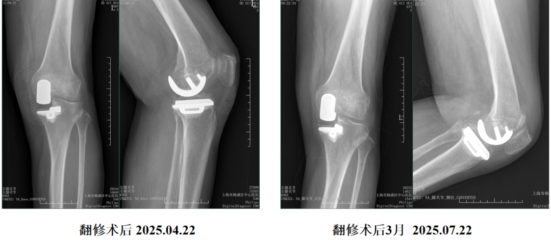单髁置换术后无菌性松动的治疗策略