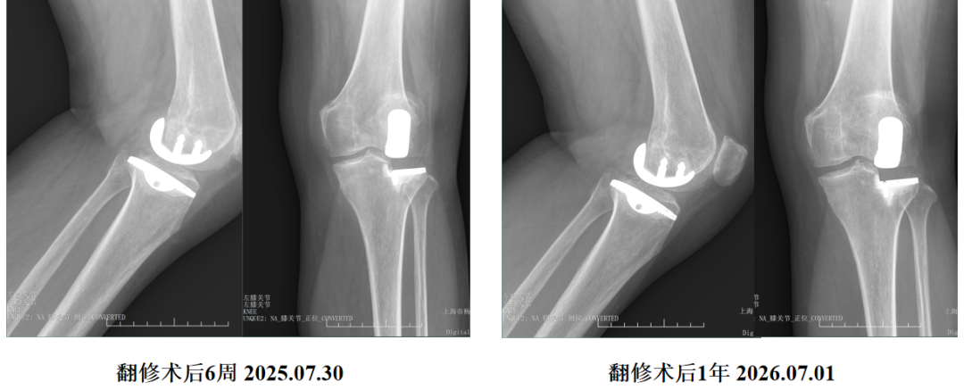 单髁置换术后无菌性松动的治疗策略