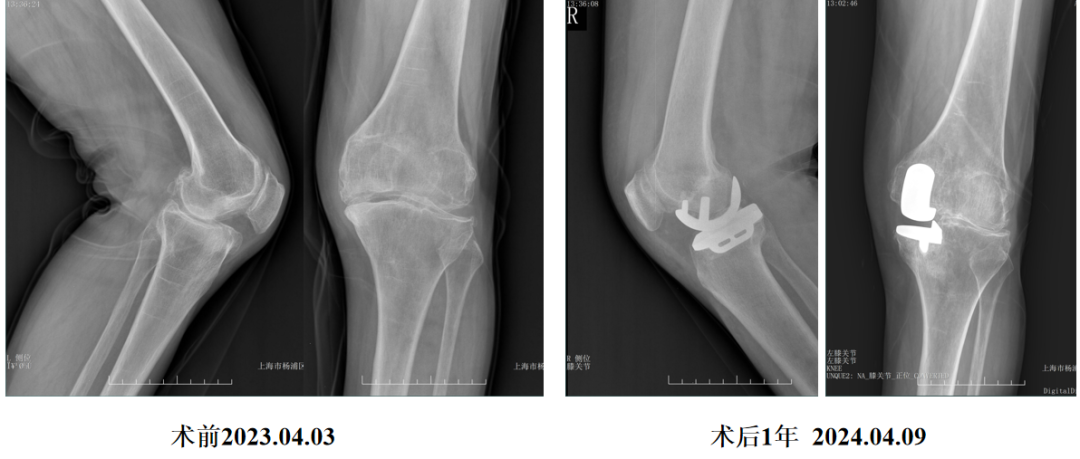单髁置换术后无菌性松动的治疗策略