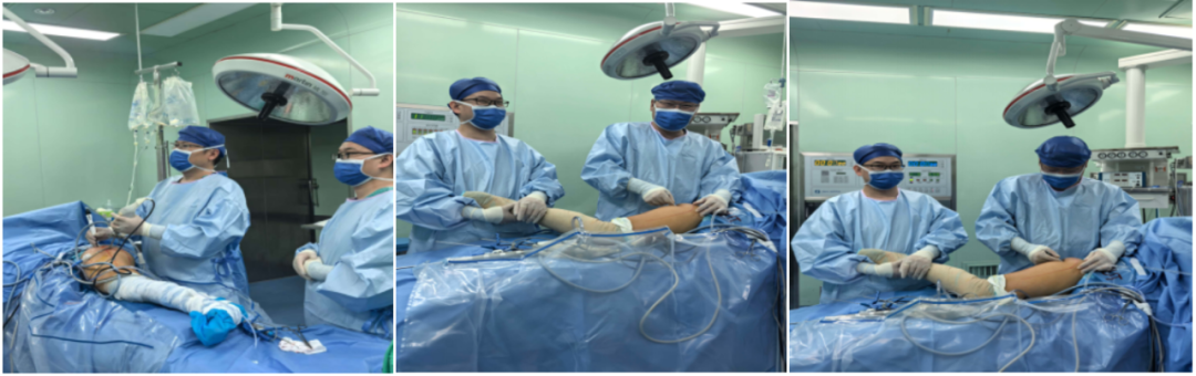 腰椎术后顽固性臀腿痛：全镜下坐骨神经松解治疗血管化束带卡压所致梨状肌综合征经验分享（第21例）