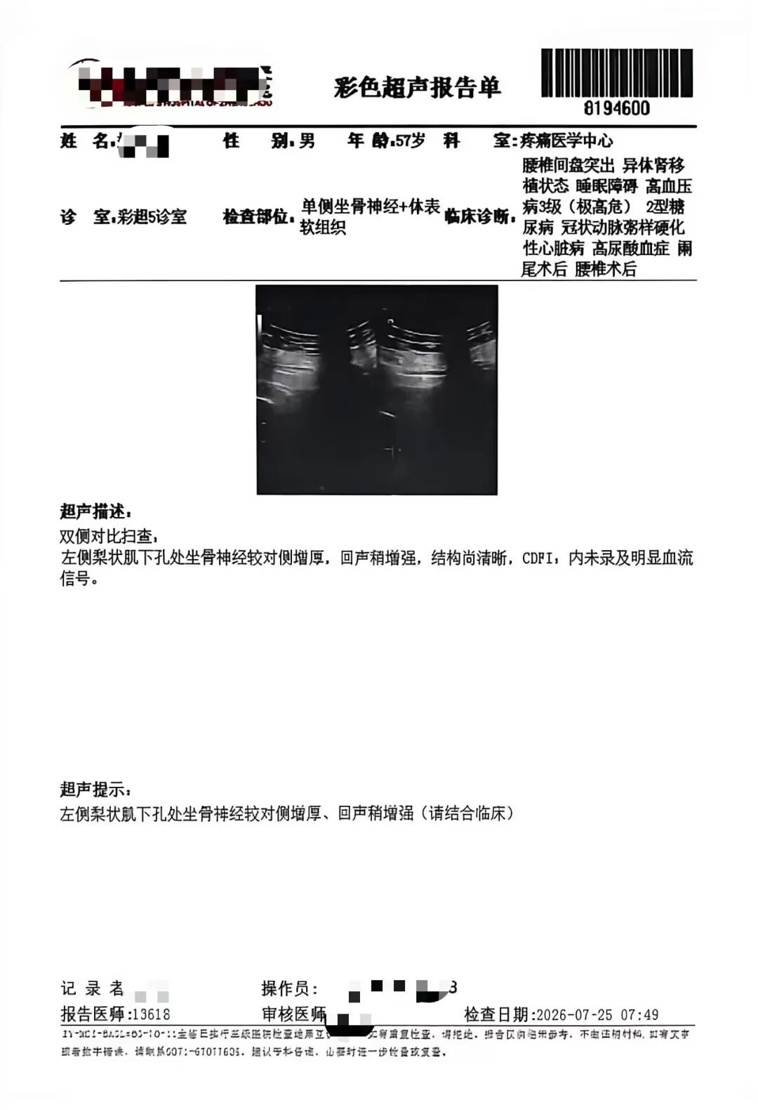 腰椎术后顽固性臀腿痛：全镜下坐骨神经松解治疗血管化束带卡压所致梨状肌综合征经验分享（第21例）