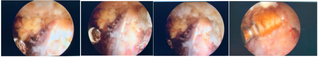 腰椎术后顽固性臀腿痛：全镜下坐骨神经松解治疗血管化束带卡压所致梨状肌综合征经验分享（第21例）