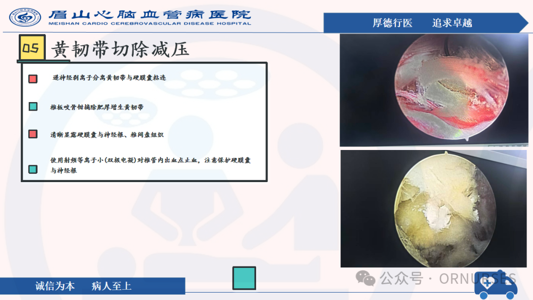 【图文课件】双通道脊柱内镜下(UBE）椎管扩大减压术