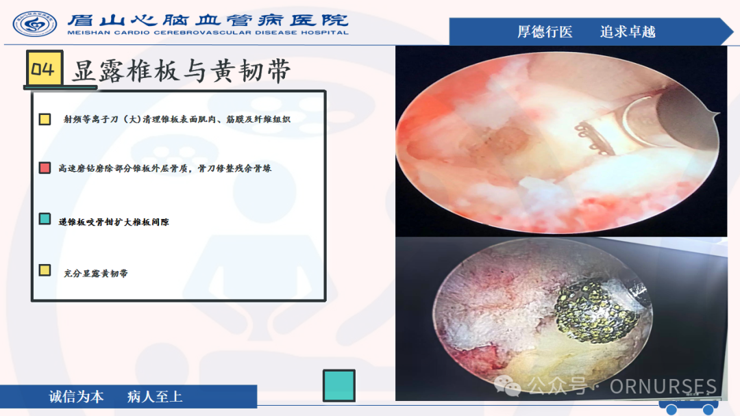 【图文课件】双通道脊柱内镜下(UBE）椎管扩大减压术