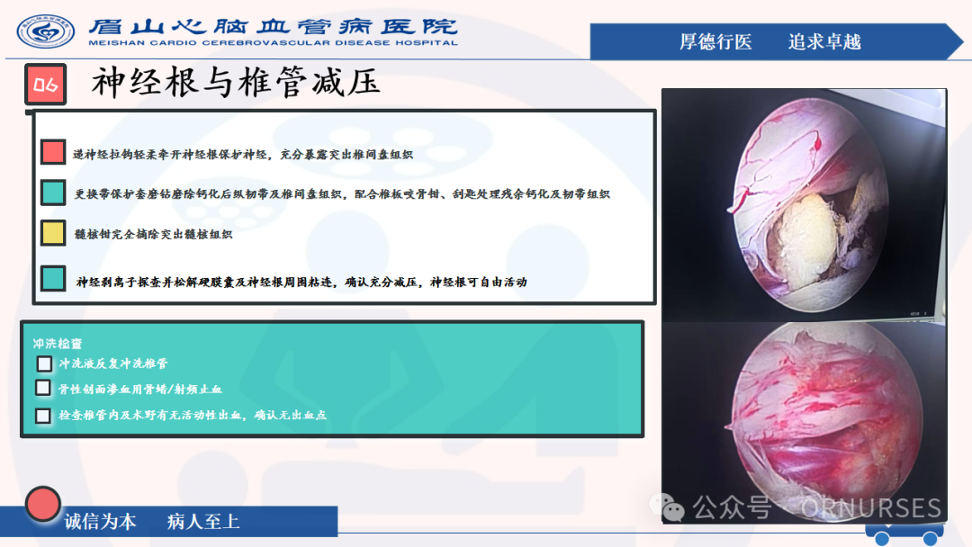 【图文课件】双通道脊柱内镜下(UBE）椎管扩大减压术