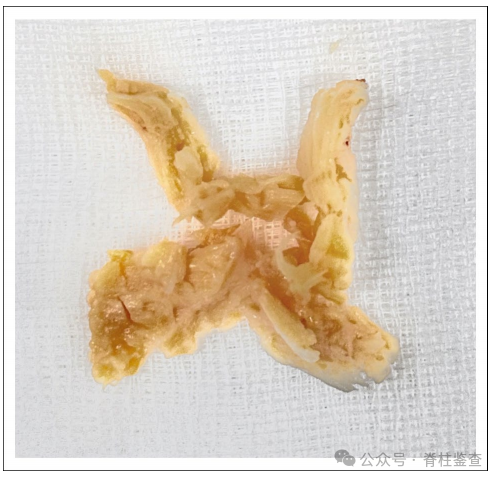 UBE治疗腰椎退行性疾病: