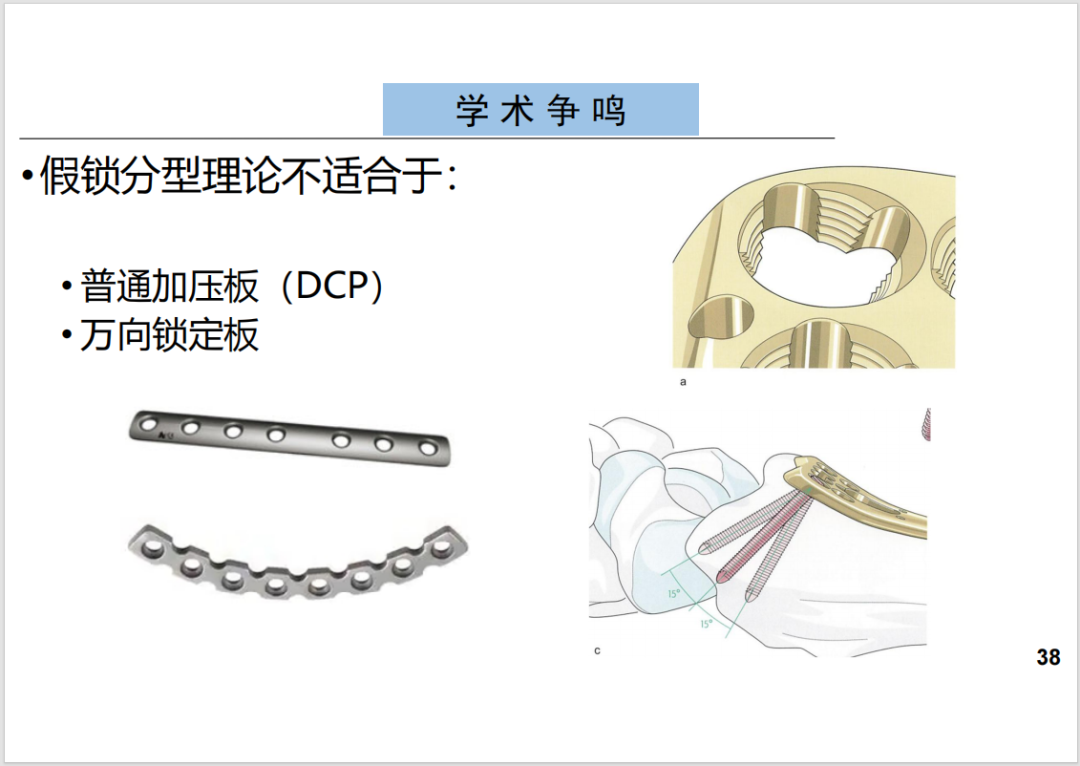 锁定接骨板