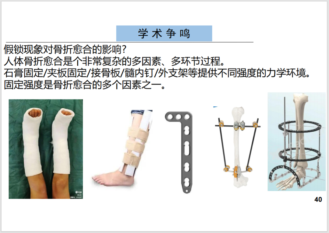 锁定接骨板