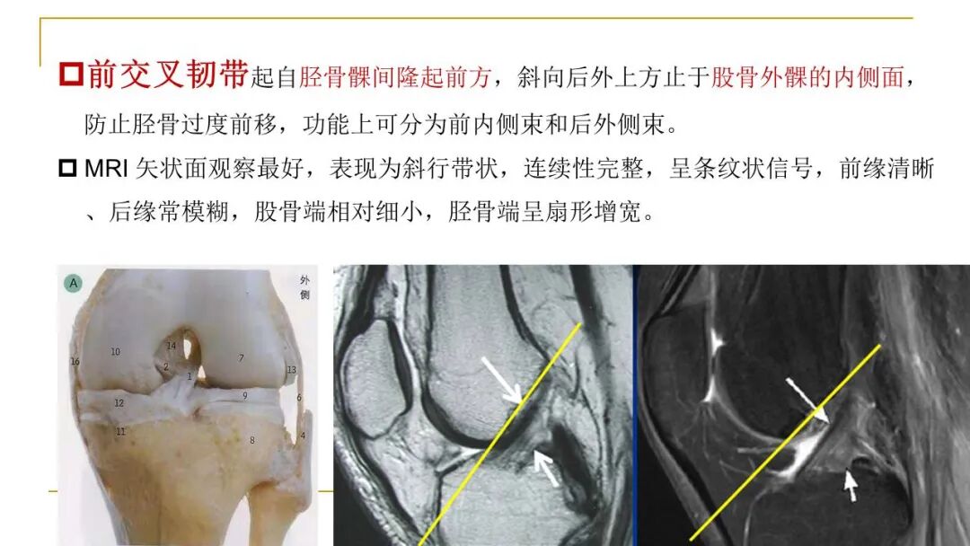 【图文并茂】膝关节MRI解剖及常见病诊断