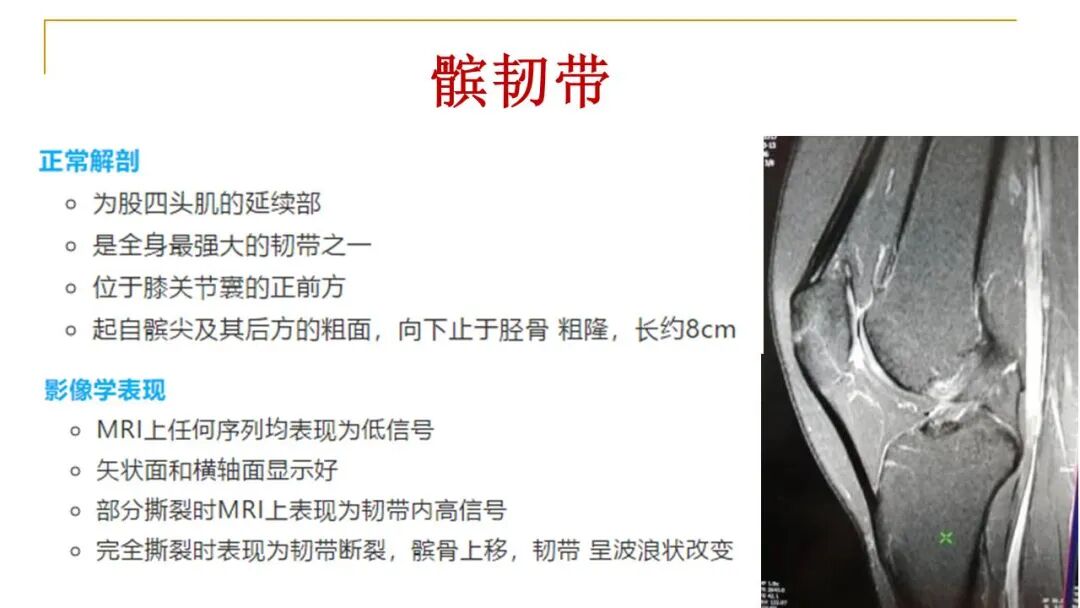 【图文并茂】膝关节MRI解剖及常见病诊断