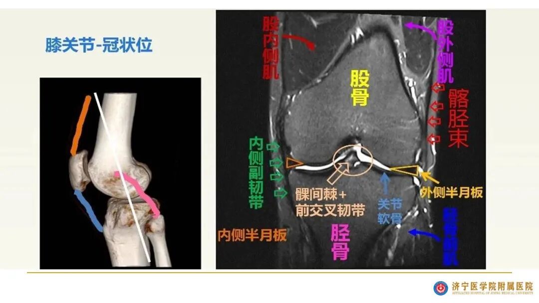 【图文并茂】膝关节MRI解剖及常见病诊断