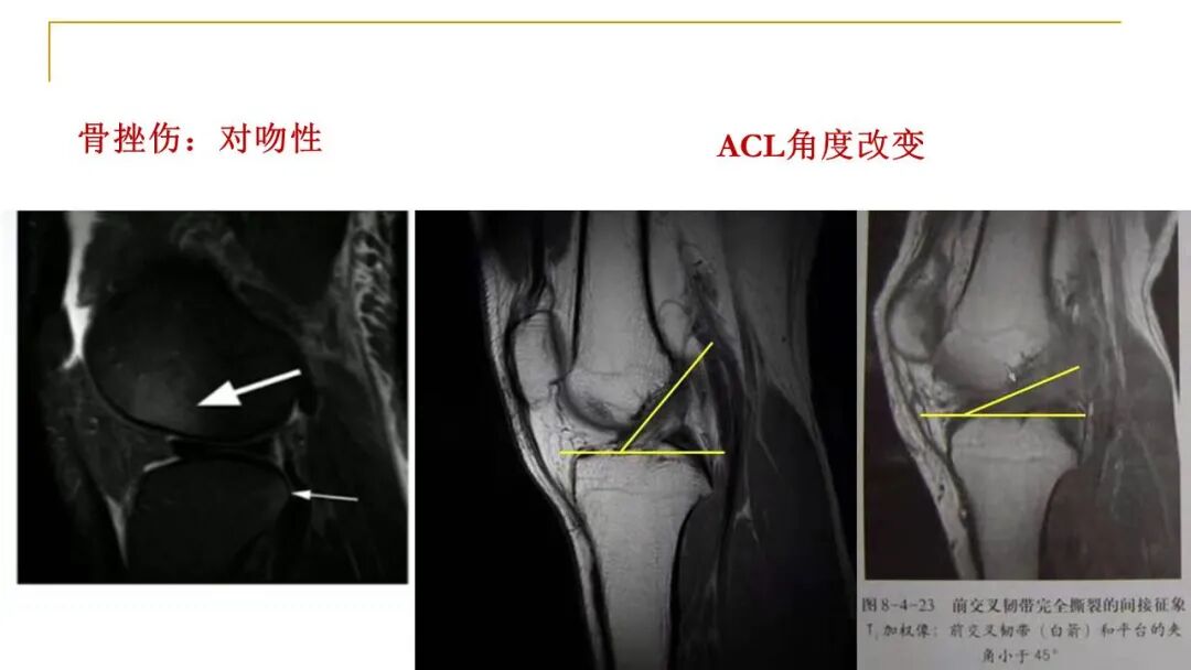 【图文并茂】膝关节MRI解剖及常见病诊断