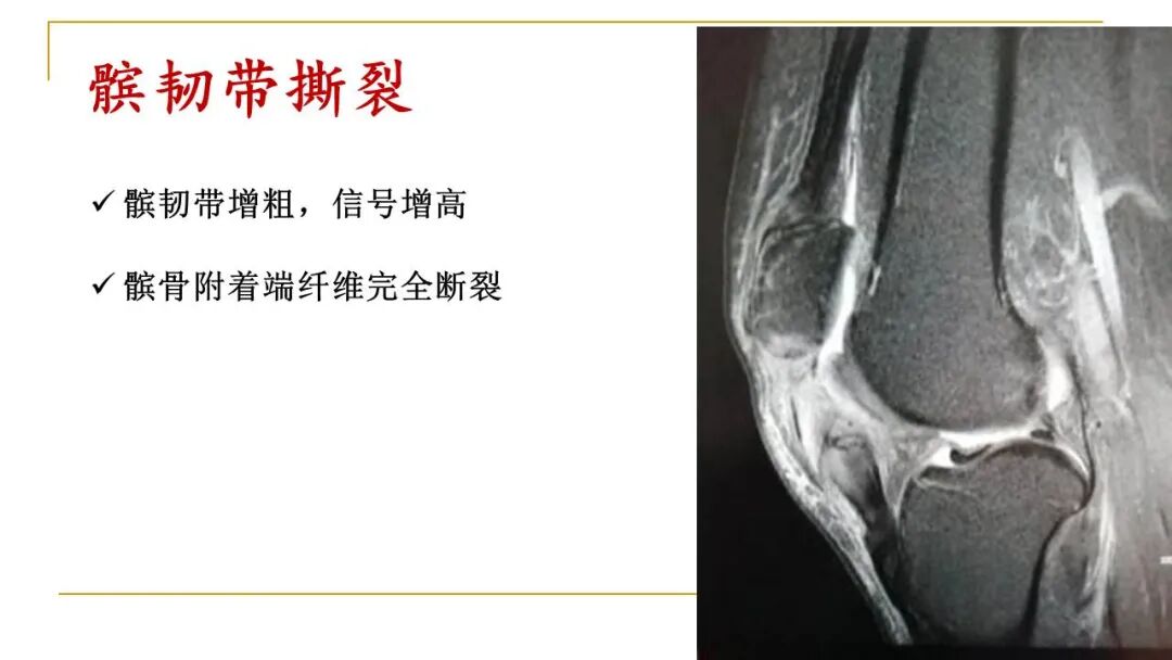 【图文并茂】膝关节MRI解剖及常见病诊断