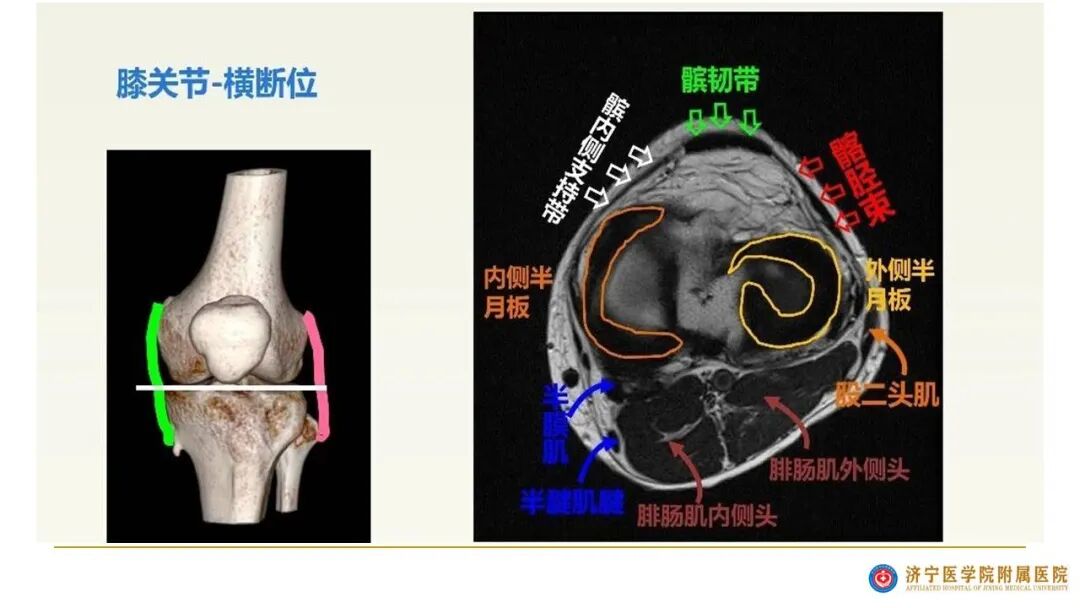 【图文并茂】膝关节MRI解剖及常见病诊断