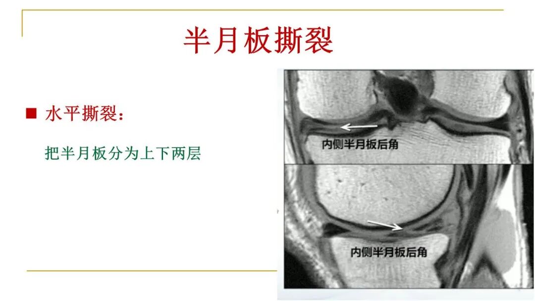 【图文并茂】膝关节MRI解剖及常见病诊断