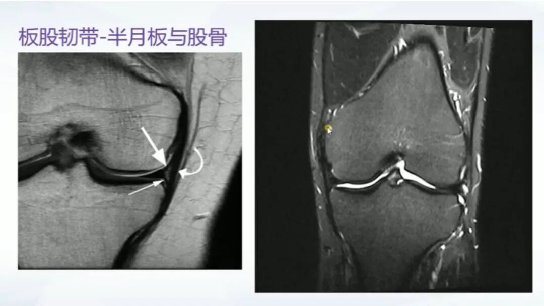 【图文并茂】膝关节MRI解剖及常见病诊断