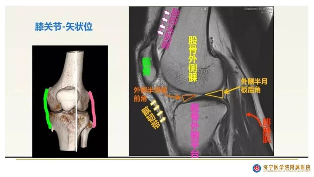【图文并茂】膝关节MRI解剖及常见病诊断