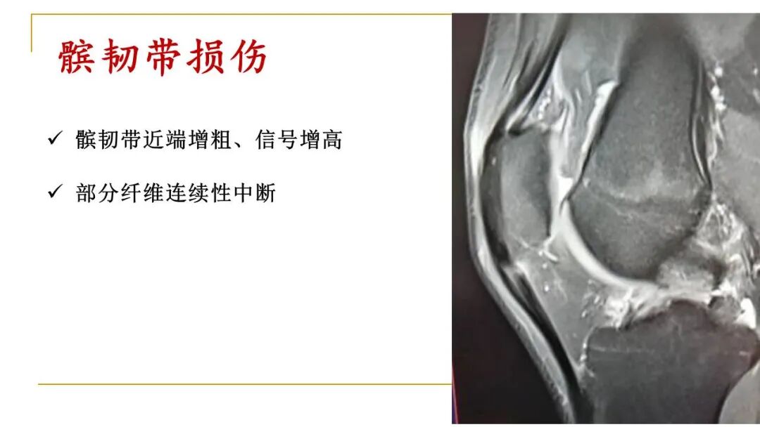 【图文并茂】膝关节MRI解剖及常见病诊断