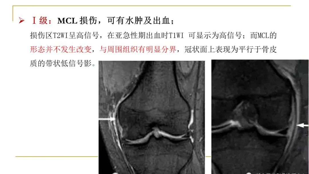 【图文并茂】膝关节MRI解剖及常见病诊断