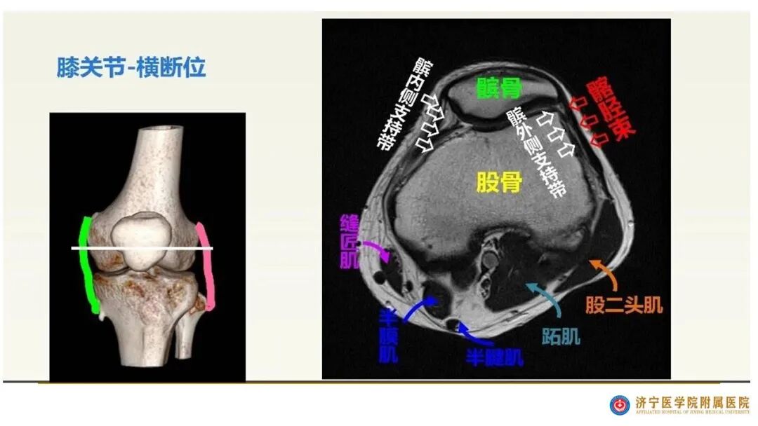 【图文并茂】膝关节MRI解剖及常见病诊断