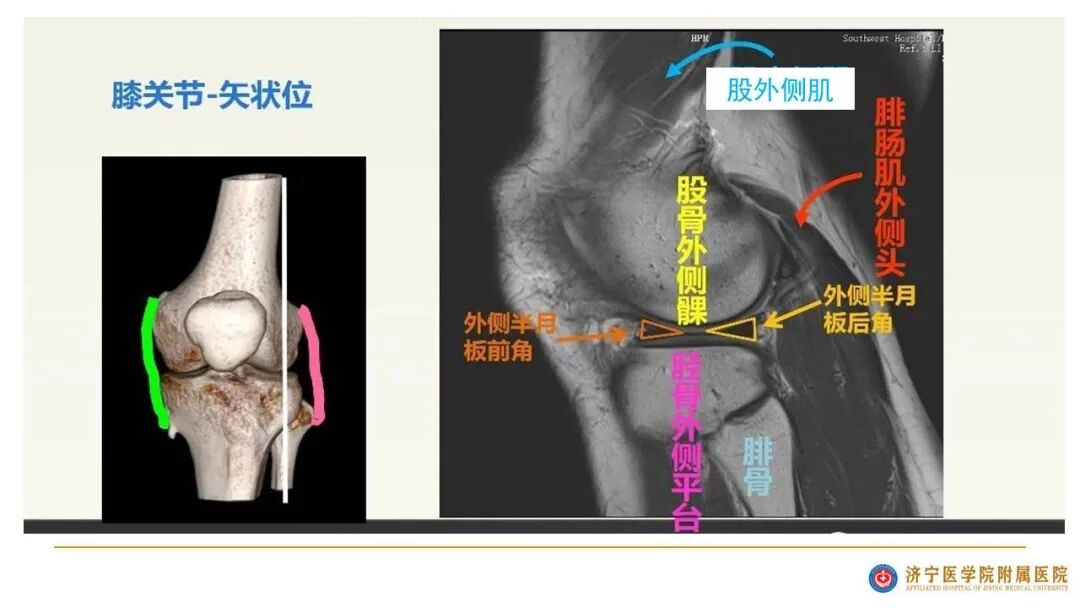 【图文并茂】膝关节MRI解剖及常见病诊断