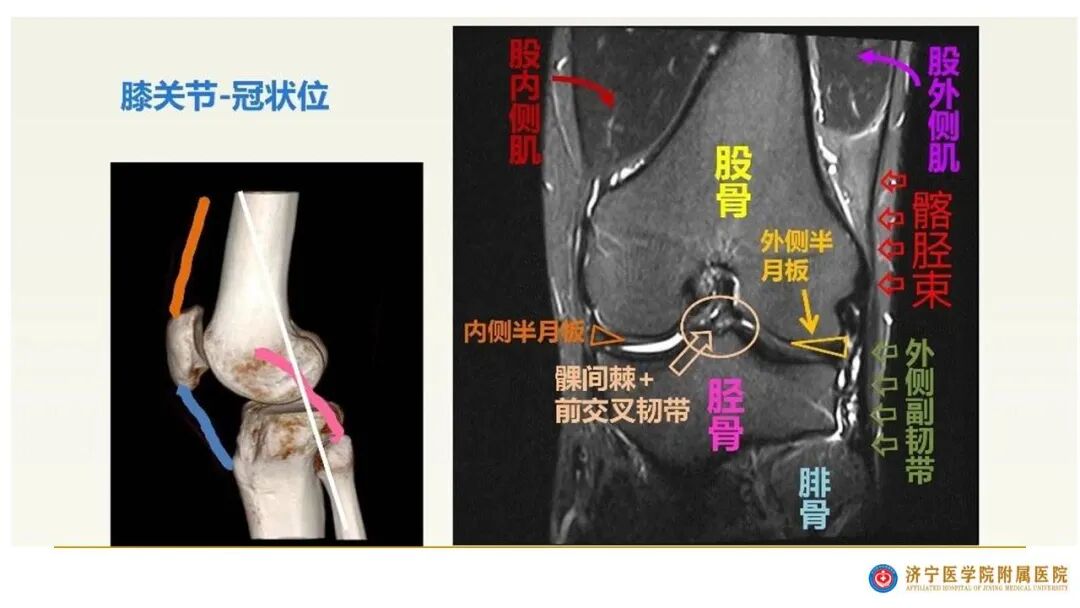 【图文并茂】膝关节MRI解剖及常见病诊断