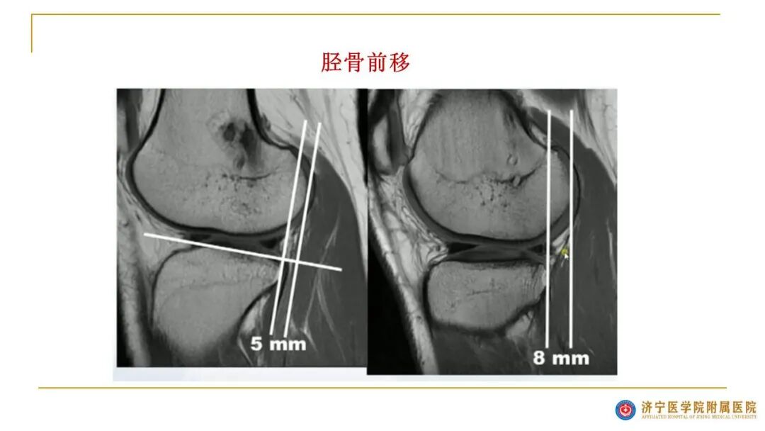 【图文并茂】膝关节MRI解剖及常见病诊断