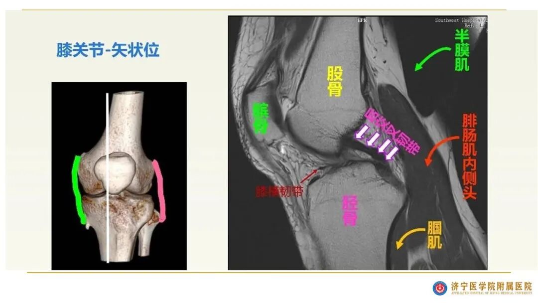 【图文并茂】膝关节MRI解剖及常见病诊断
