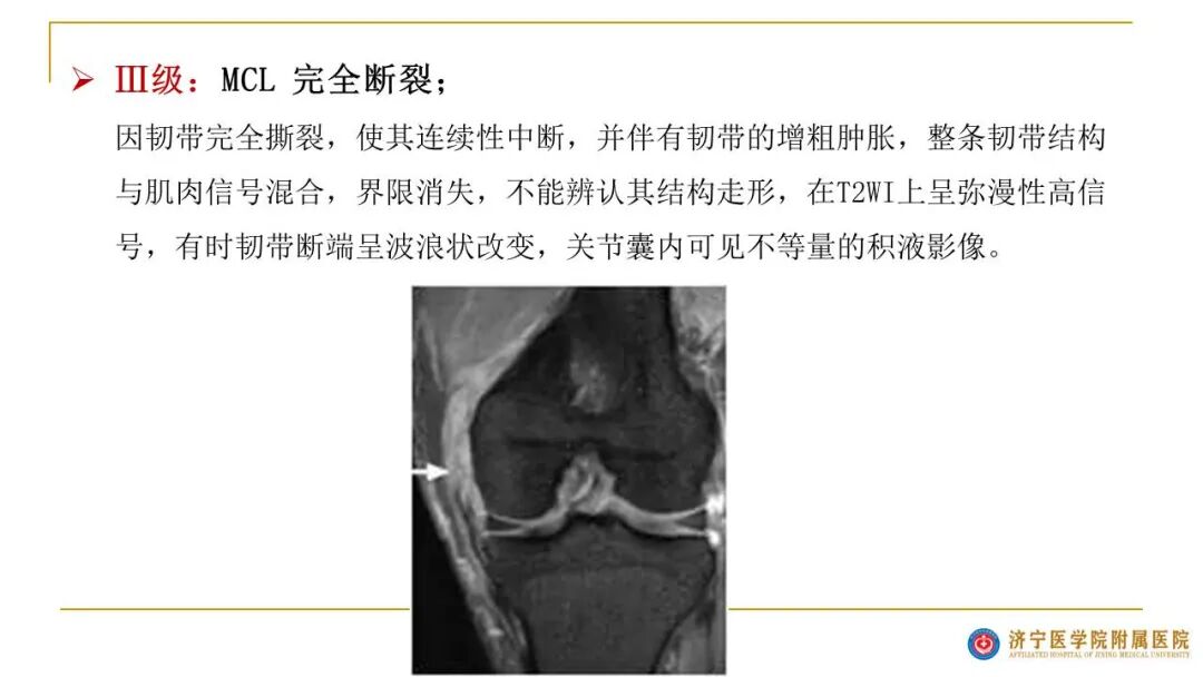 【图文并茂】膝关节MRI解剖及常见病诊断