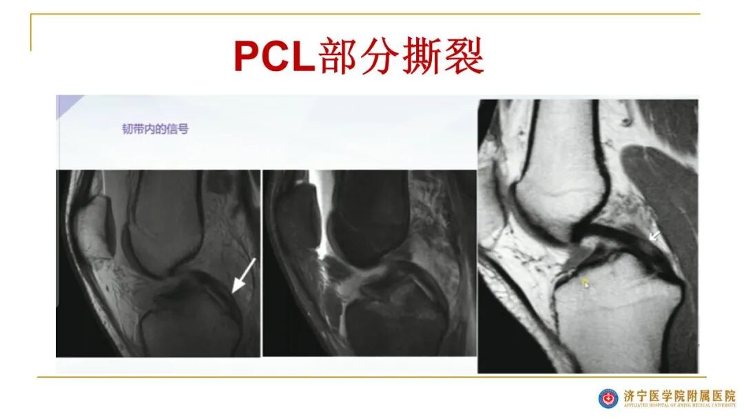 【图文并茂】膝关节MRI解剖及常见病诊断