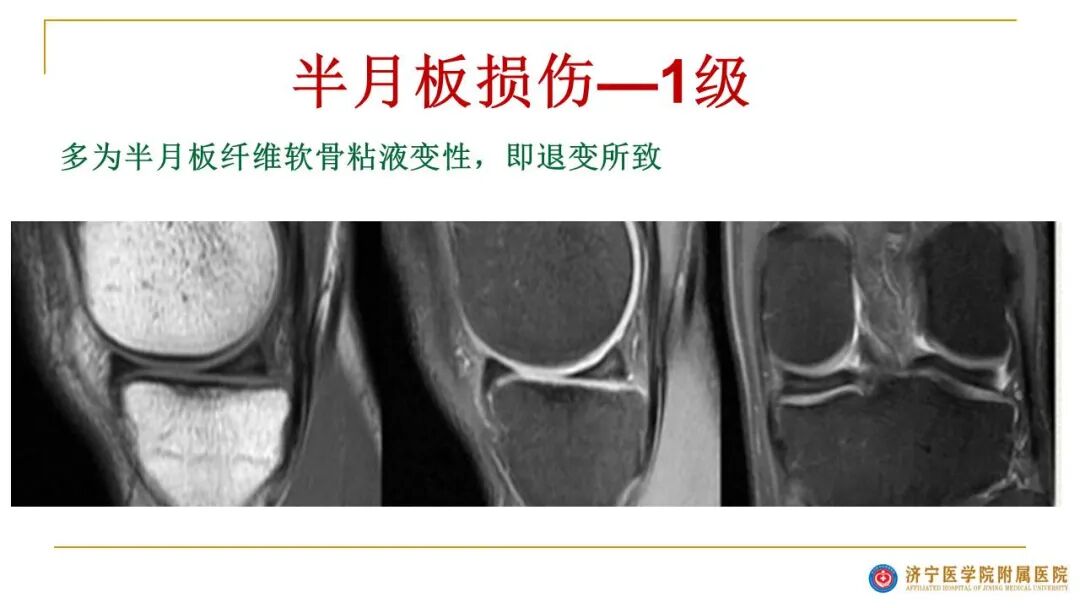 【图文并茂】膝关节MRI解剖及常见病诊断